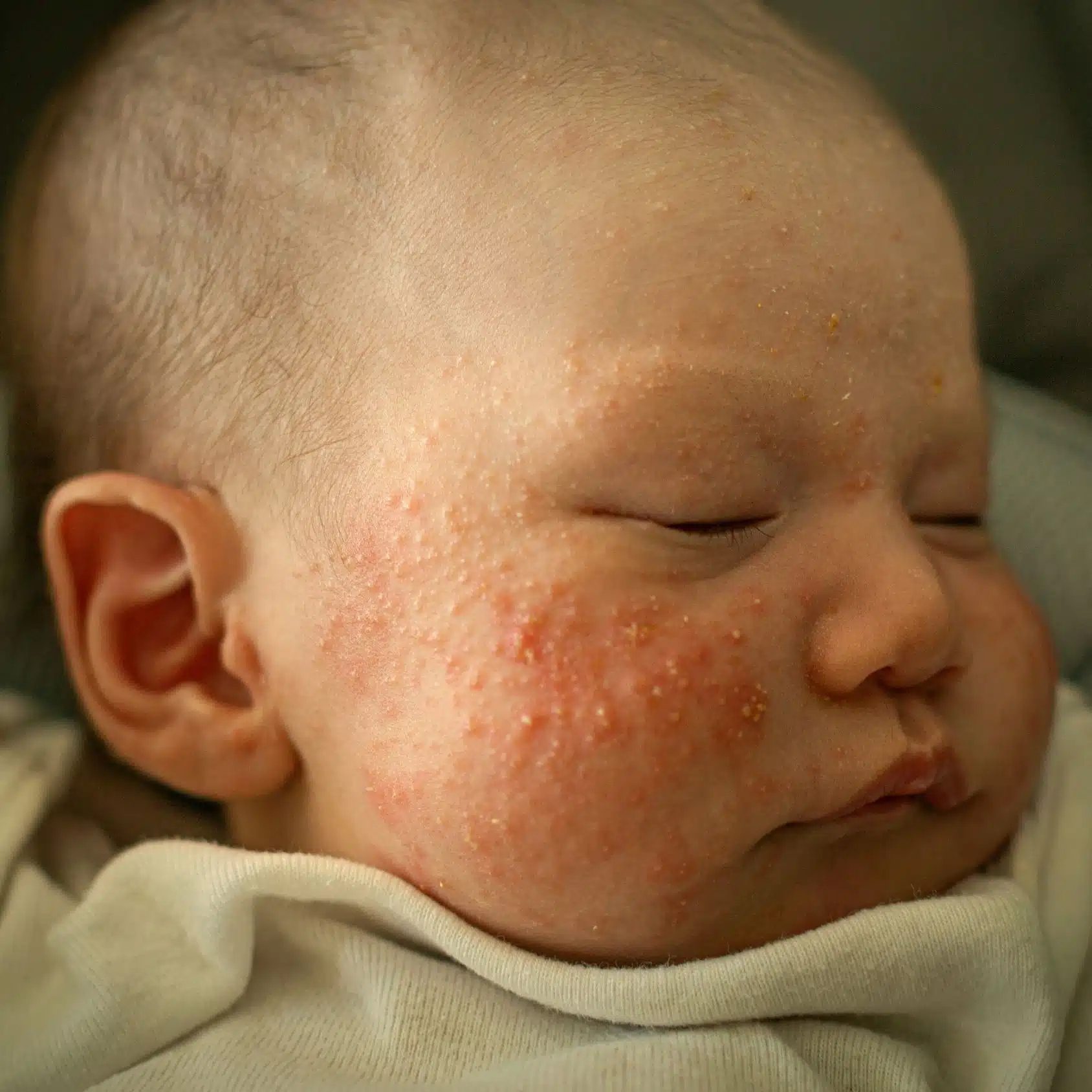baby eczema vs acne